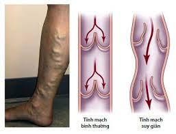 Hỗ trợ điều trị giãn tĩnh mạch bằng sóng Teraherzt